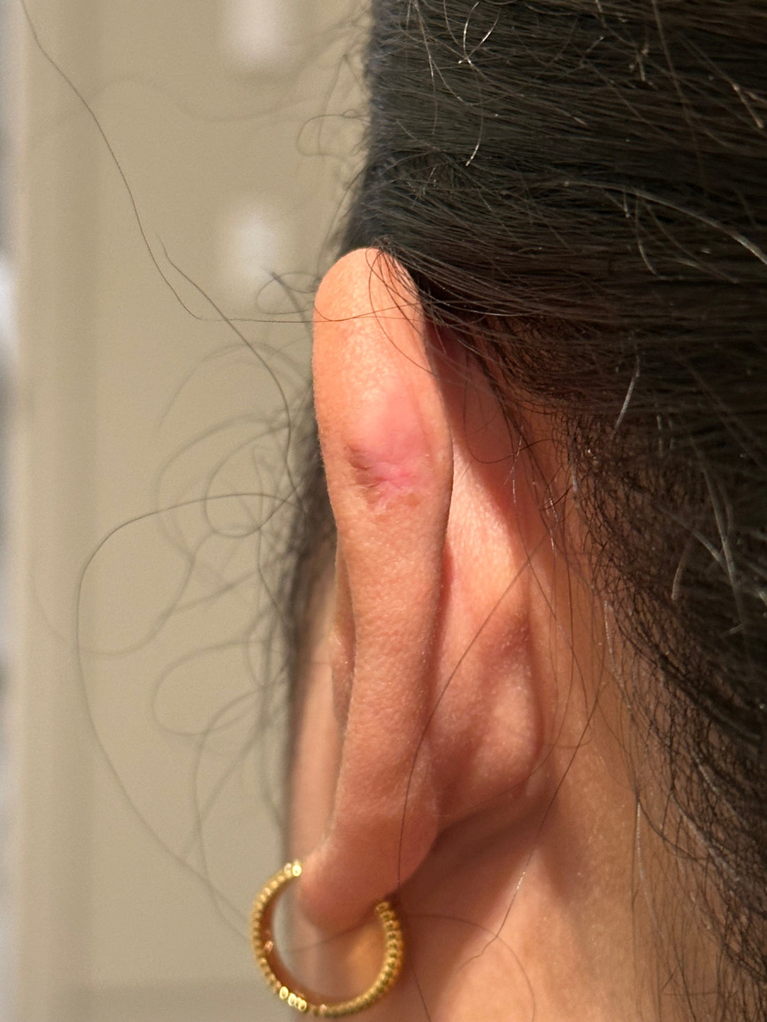 How get rid of the scar tissue when piercing healed?