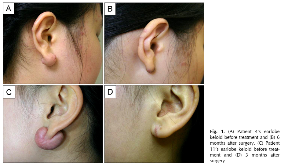 Managing Earlobe Keloids: Evidence-Based Use of Intralesional Corticosteroid Injection